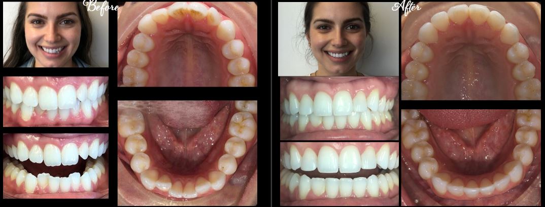Before and After Invisalign Clear Braces