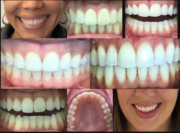 Before & After Dental Procedure CT Stamford Dental Arts