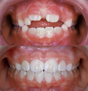 Open Bite Correction