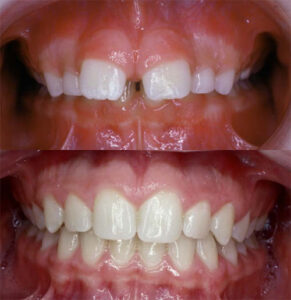 Overbite Correction