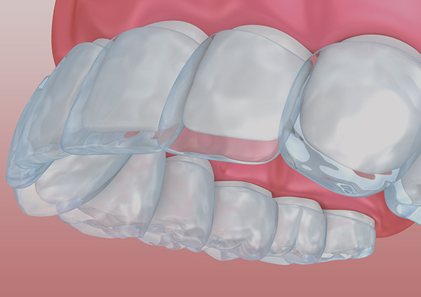 Invisalign for Uneven Bite